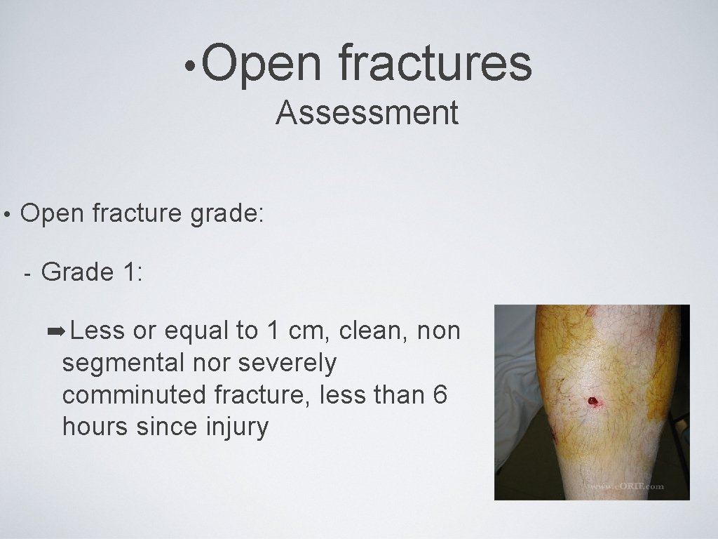  • Open fractures Assessment • Open fracture grade: - Grade 1: ➡ Less