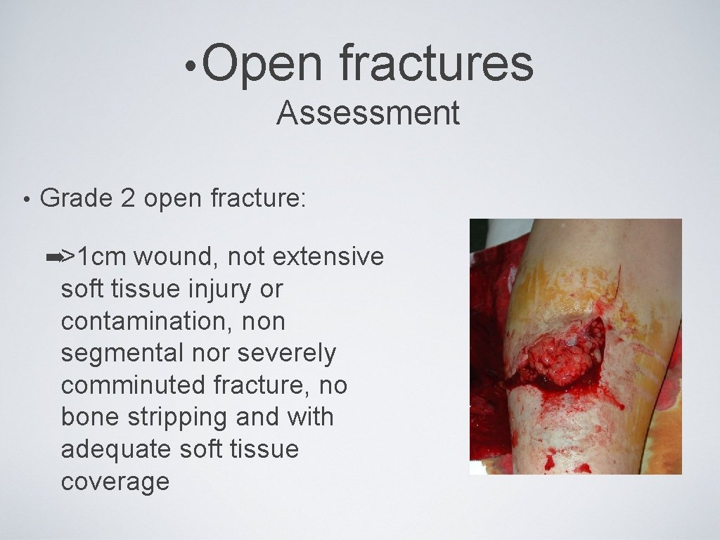  • Open fractures Assessment • Grade 2 open fracture: ➡>1 cm wound, not