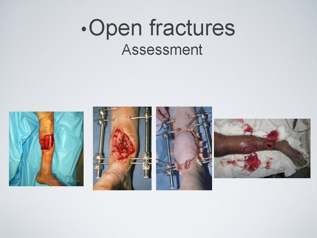  • Open fractures Assessment 