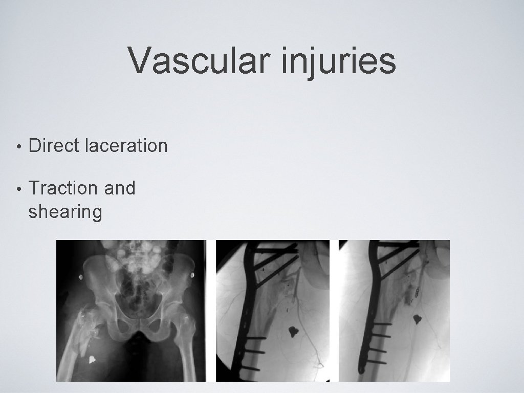 Vascular injuries • Direct laceration • Traction and shearing 