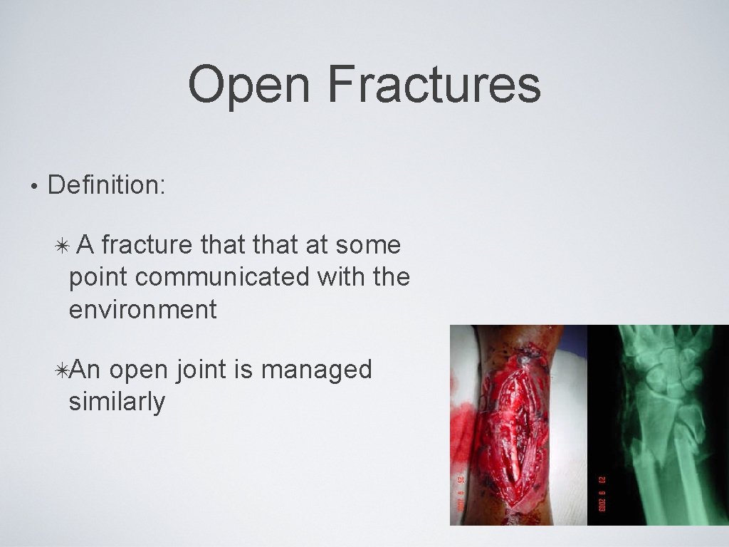 Open Fractures • Definition: ✴A fracture that at some point communicated with the environment