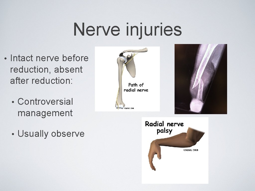 Nerve injuries • Intact nerve before reduction, absent after reduction: • Controversial management •