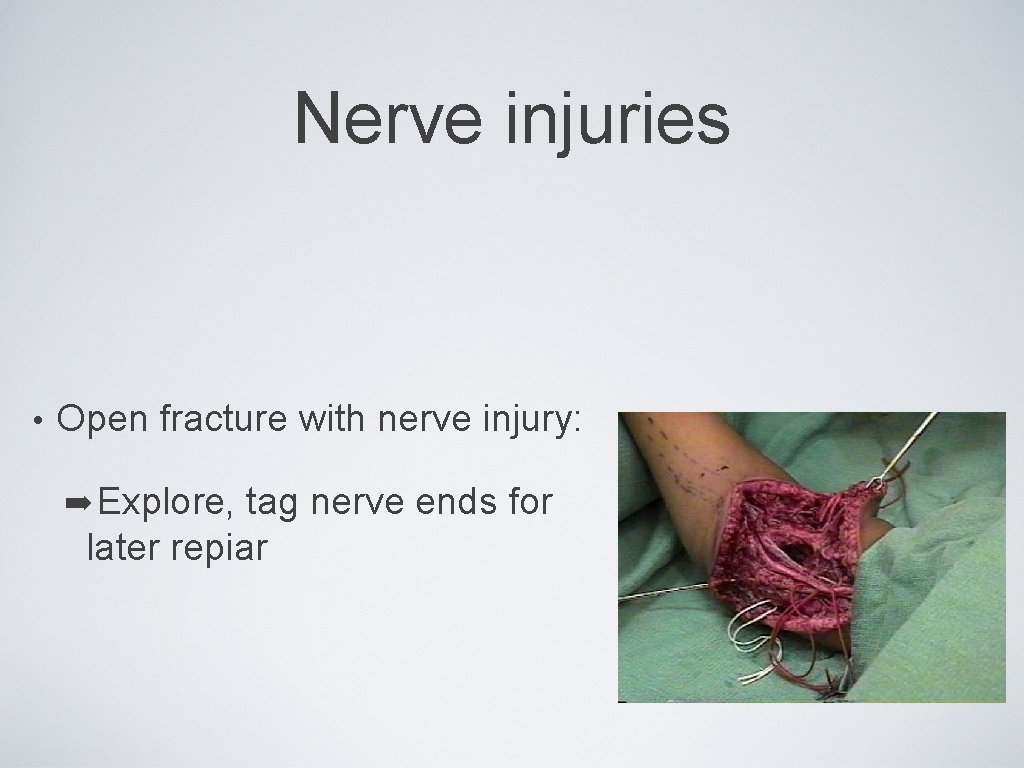 Nerve injuries • Open fracture with nerve injury: ➡ Explore, tag nerve ends for