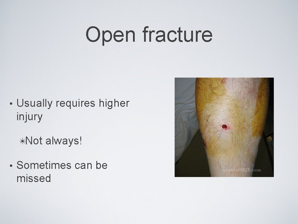 Open fracture • Usually requires higher injury ✴Not • always! Sometimes can be missed