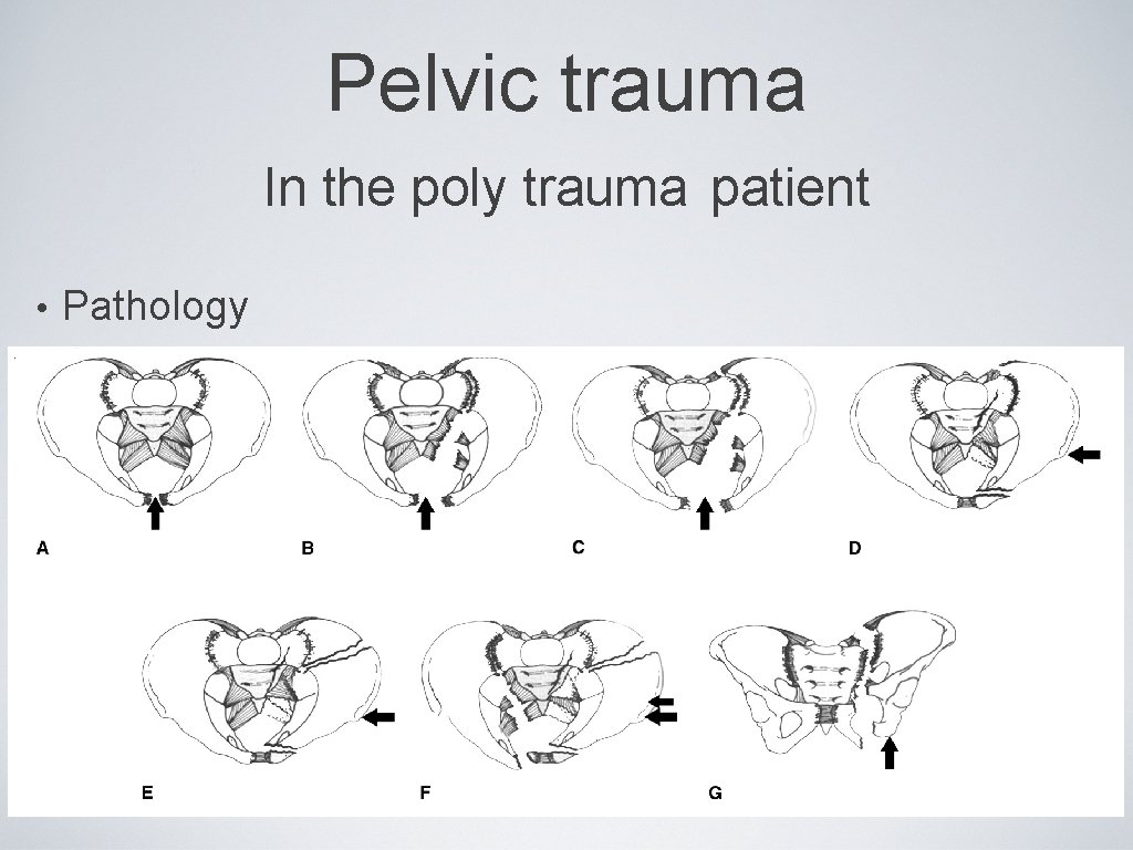 Pelvic trauma In the poly trauma patient • Pathology 