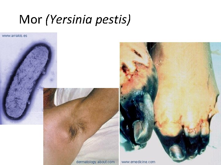 Mor (Yersinia pestis) www. arrakis. es dermatology. about. com www. emedicine. com 