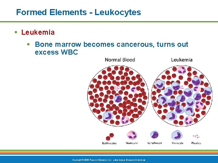 Formed Elements - Leukocytes § Leukemia § Bone marrow becomes cancerous, turns out excess