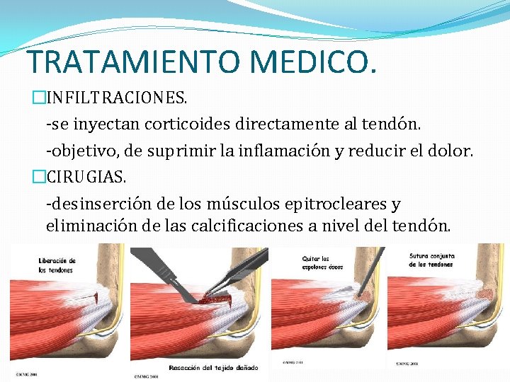 TRATAMIENTO MEDICO. �INFILTRACIONES. -se inyectan corticoides directamente al tendón. -objetivo, de suprimir la inflamación