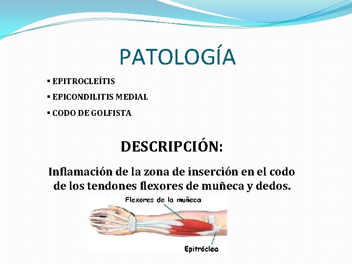 PATOLOGÍA § EPITROCLEÍTIS § EPICONDILITIS MEDIAL § CODO DE GOLFISTA DESCRIPCIÓN: Inflamación de la