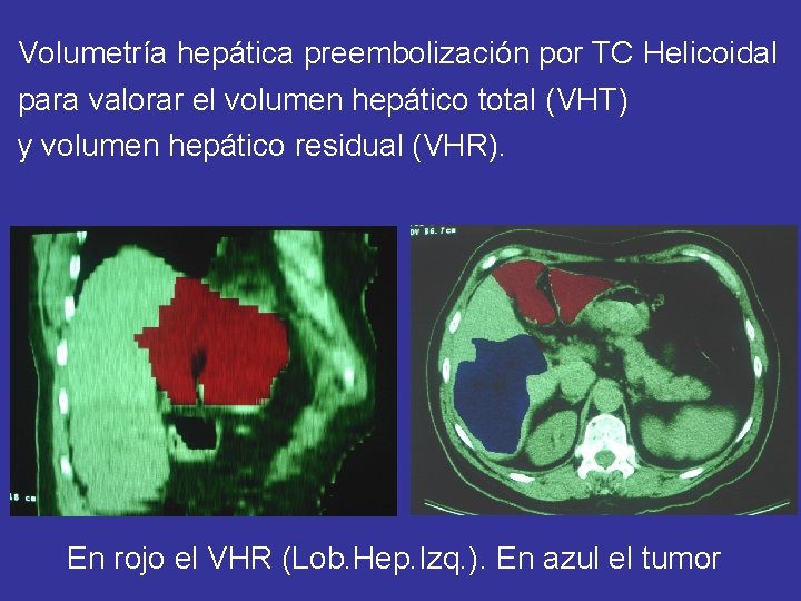 Volumetría hepática preembolización por TC Helicoidal para valorar el volumen hepático total (VHT) y