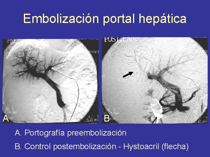 Embolización portal hepática A B A. Portografía preembolización B. Control postembolización - Hystoacril (flecha)