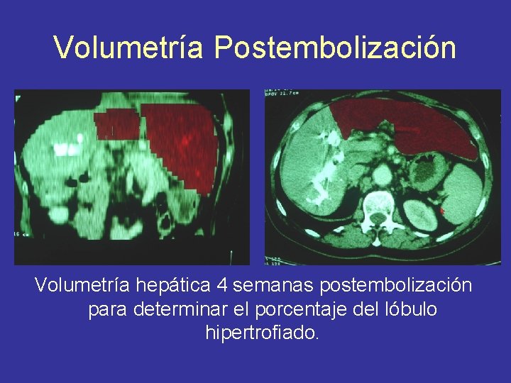 Volumetría Postembolización Volumetría hepática 4 semanas postembolización para determinar el porcentaje del lóbulo hipertrofiado.