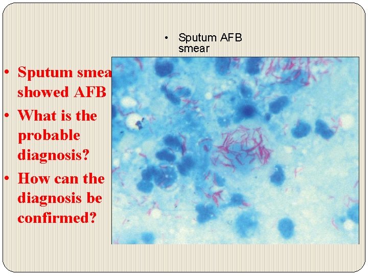  • Sputum AFB smear • Sputum smear showed AFB • What is the