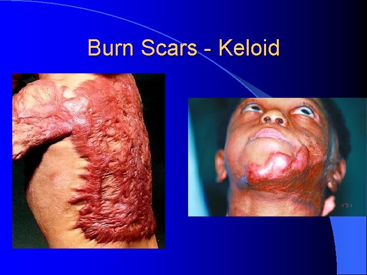 Burn Scars - Keloid 