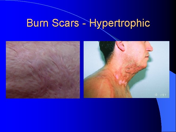 Burn Scars - Hypertrophic 