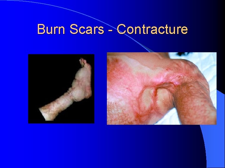Burn Scars - Contracture 