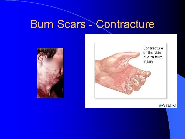 Burn Scars - Contracture 