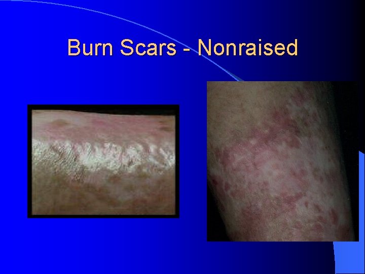 Burn Scars - Nonraised 