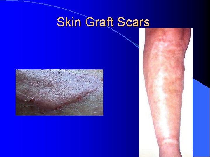 Skin Graft Scars 