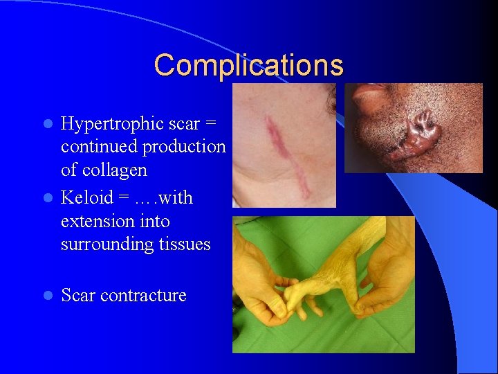 Complications Hypertrophic scar = continued production of collagen l Keloid = …. with extension