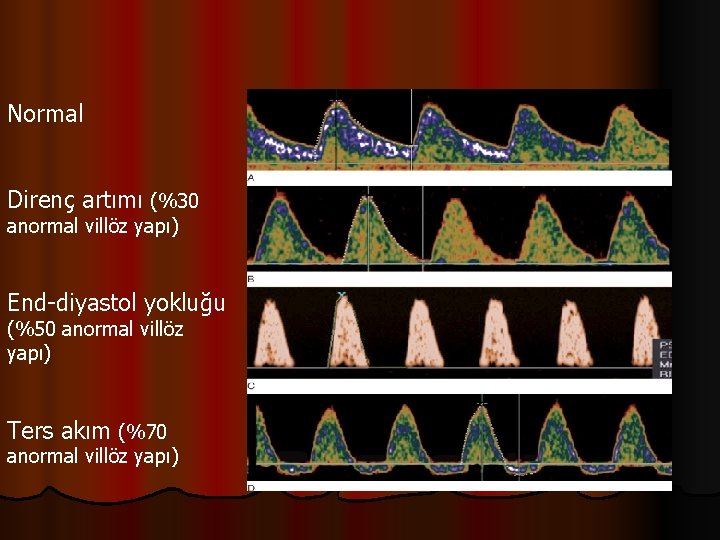 Normal Direnç artımı (%30 anormal villöz yapı) End-diyastol yokluğu (%50 anormal villöz yapı) Ters