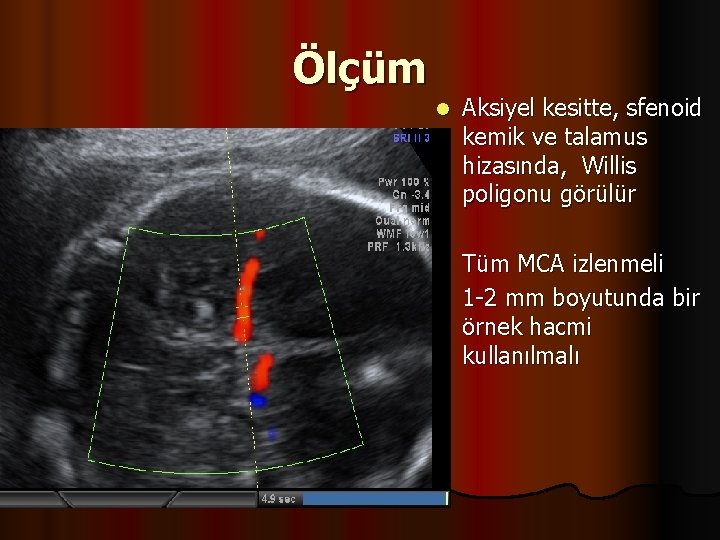 Ölçüm l Aksiyel kesitte, sfenoid kemik ve talamus hizasında, Willis poligonu görülür Tüm MCA