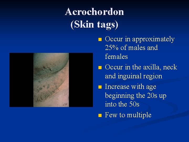 Acrochordon (Skin tags) n n Occur in approximately 25% of males and females Occur