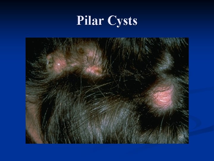 Pilar Cysts 