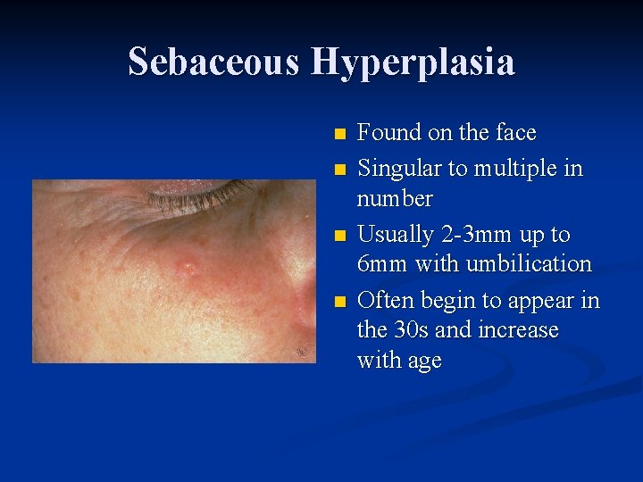 Sebaceous Hyperplasia n n Found on the face Singular to multiple in number Usually