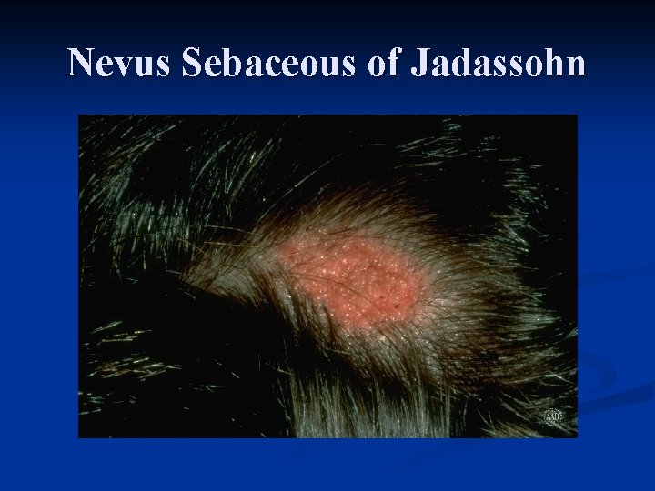 Nevus Sebaceous of Jadassohn 