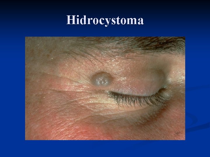 Hidrocystoma 
