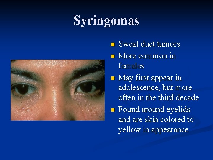 Syringomas n n Sweat duct tumors More common in females May first appear in