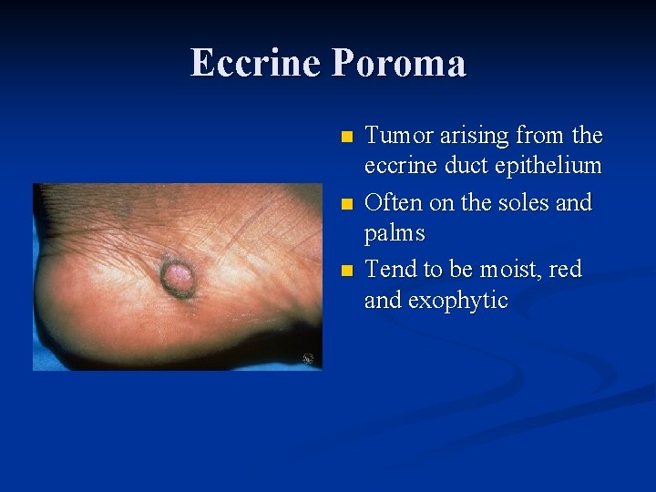 Eccrine Poroma n n n Tumor arising from the eccrine duct epithelium Often on