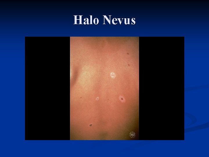 Halo Nevus 