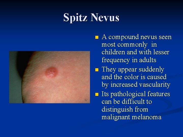 Spitz Nevus n n n A compound nevus seen most commonly in children and