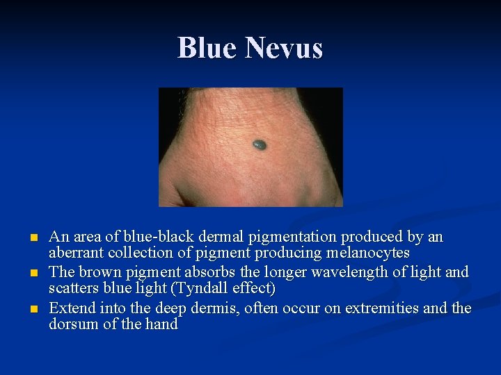 Blue Nevus n n n An area of blue-black dermal pigmentation produced by an