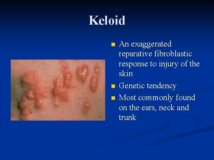 Keloid n n n An exaggerated reparative fibroblastic response to injury of the skin