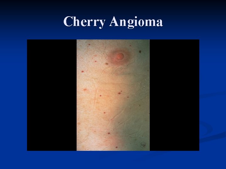 Cherry Angioma 