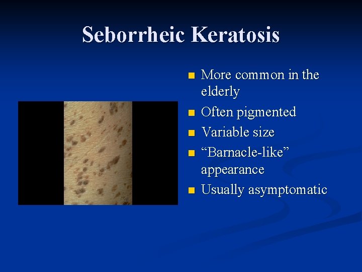 Seborrheic Keratosis n n n More common in the elderly Often pigmented Variable size