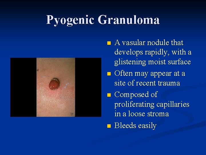 Pyogenic Granuloma n n A vasular nodule that develops rapidly, with a glistening moist