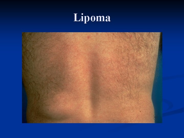 Lipoma 
