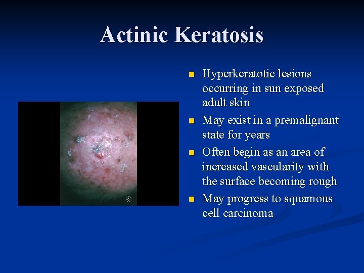 Actinic Keratosis n n Hyperkeratotic lesions occurring in sun exposed adult skin May exist