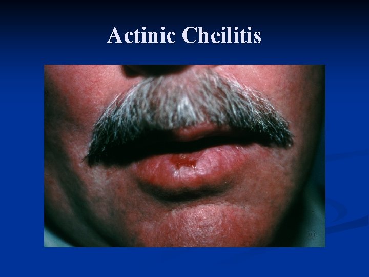 Actinic Cheilitis 