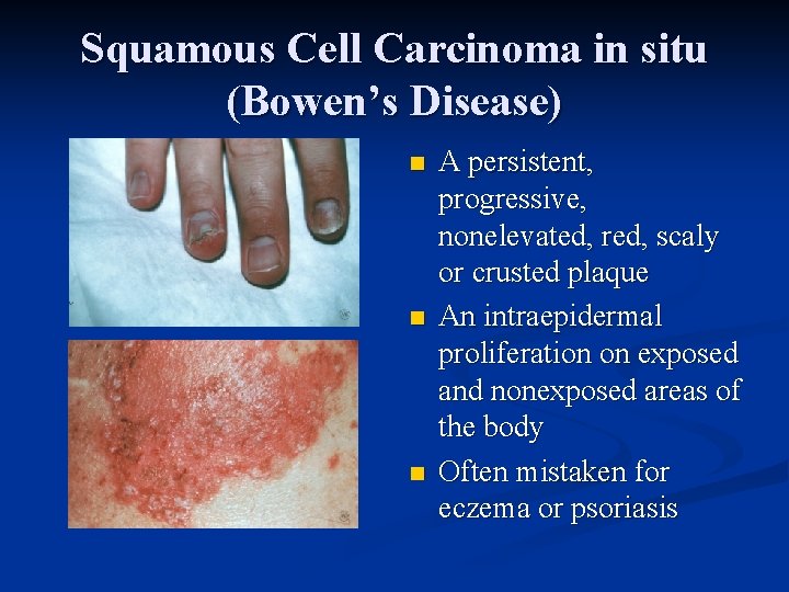 Squamous Cell Carcinoma in situ (Bowen’s Disease) n n n A persistent, progressive, nonelevated,