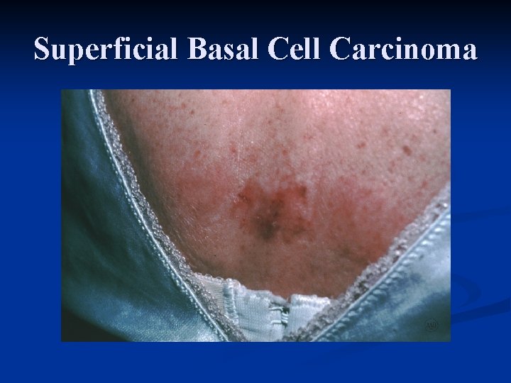 Superficial Basal Cell Carcinoma 