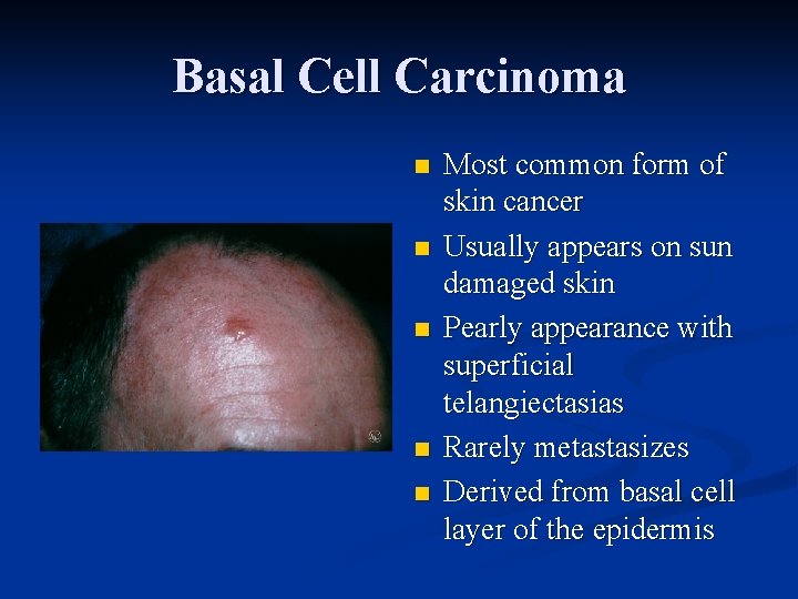 Basal Cell Carcinoma n n n Most common form of skin cancer Usually appears