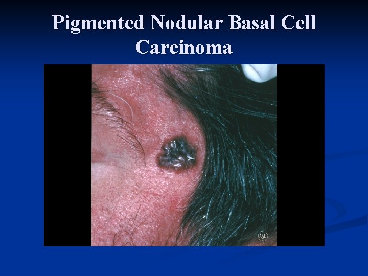 Pigmented Nodular Basal Cell Carcinoma 