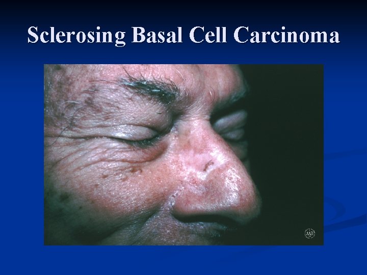 Sclerosing Basal Cell Carcinoma 