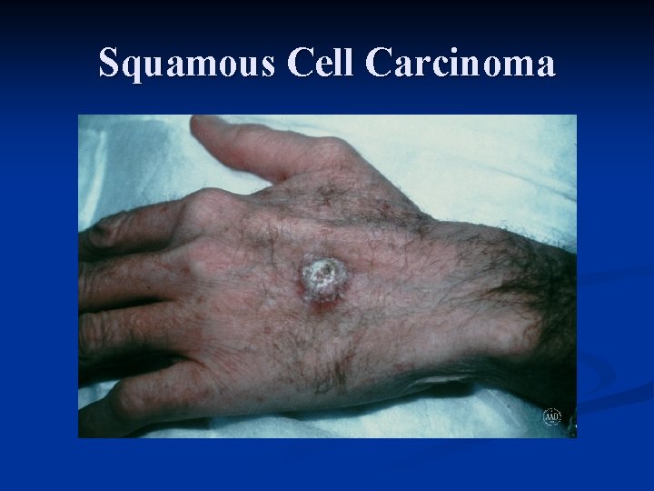 Squamous Cell Carcinoma 
