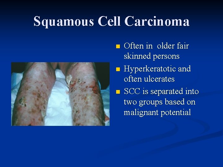 Squamous Cell Carcinoma n n n Often in older fair skinned persons Hyperkeratotic and